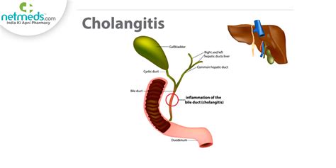 bile leakage symptoms|Cholangitis: Types, Symptoms, Treatment